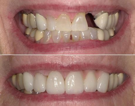 woman smiling after a dental implant procedure in Arden Arcade, CA